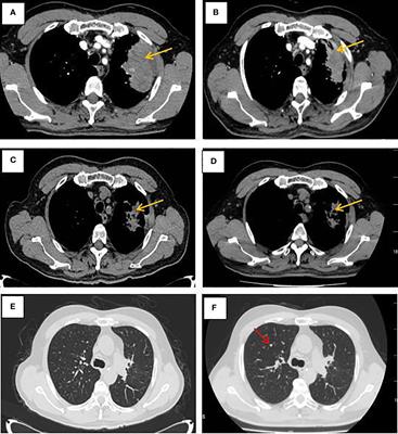 Successful first-line treatment of simultaneous multiple primary malignancies of lung adenocarcinoma and renal clear cell carcinoma: A case report